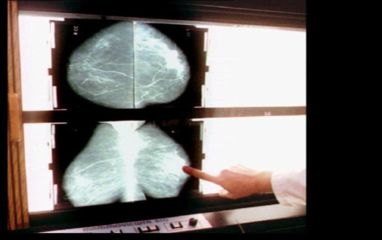 Rate of breast cancer overdiagnosis is on the rise (Photo courtesy of the Associated Press)