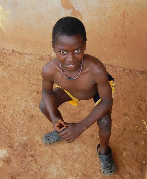 Adolf Baguma hasn't been able to stand or walk since he was burned at the age of six (Children's Burn Foundation).