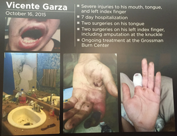 Injuries sustained to Vicente Garza (Image provided by Gregory Bentley, photo by David Merrell)